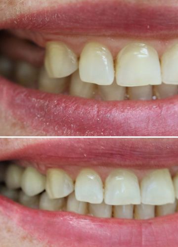 Metālkeramikas tilts + 2 zoba implanti