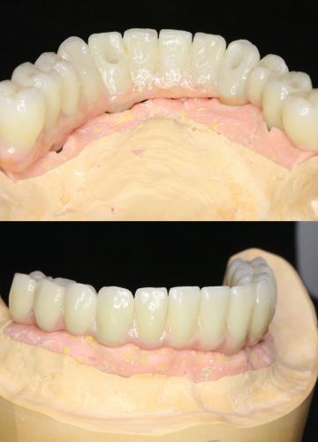 Slāņota Cirkonijkeramikas konstrukcija uz 4 implantiem