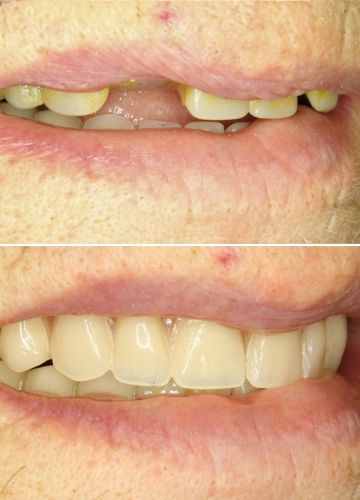 Uz  4 implantiem balstīta augšžokļa protēze