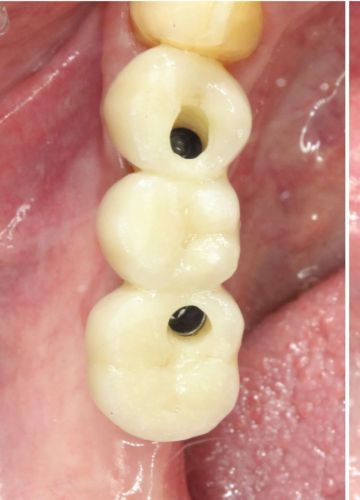 Uz 2 implantiem balstīts cirkonijkeramikas tilts